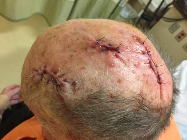 Head's Up: Doyle Brunson Survives Surgery