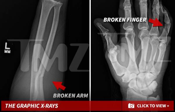 X-Rays Obtained in Alleged Floyd Mayweather Vegas Assault 