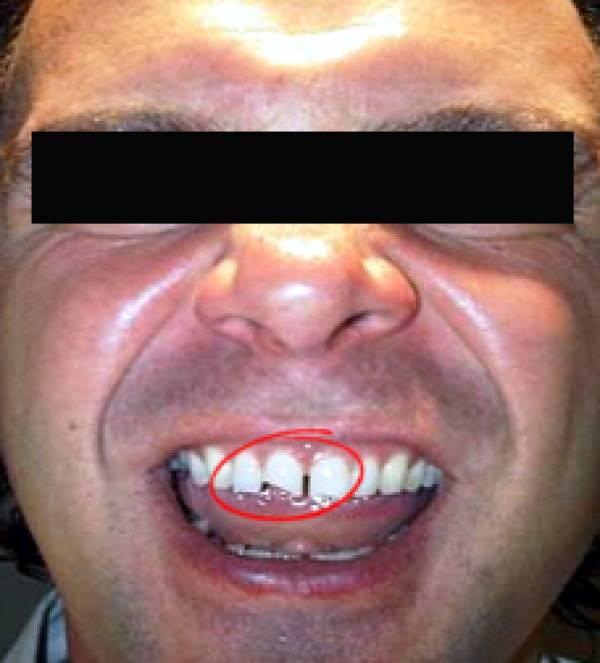 Michael Caselli Teeth Michael Caselli Teeth