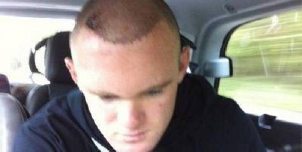 Wayne Rooney Hair Transplant